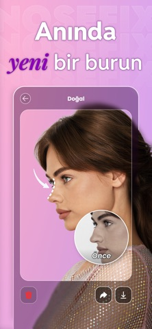 Burun D�zeltme AI: Nosefix Resimleri